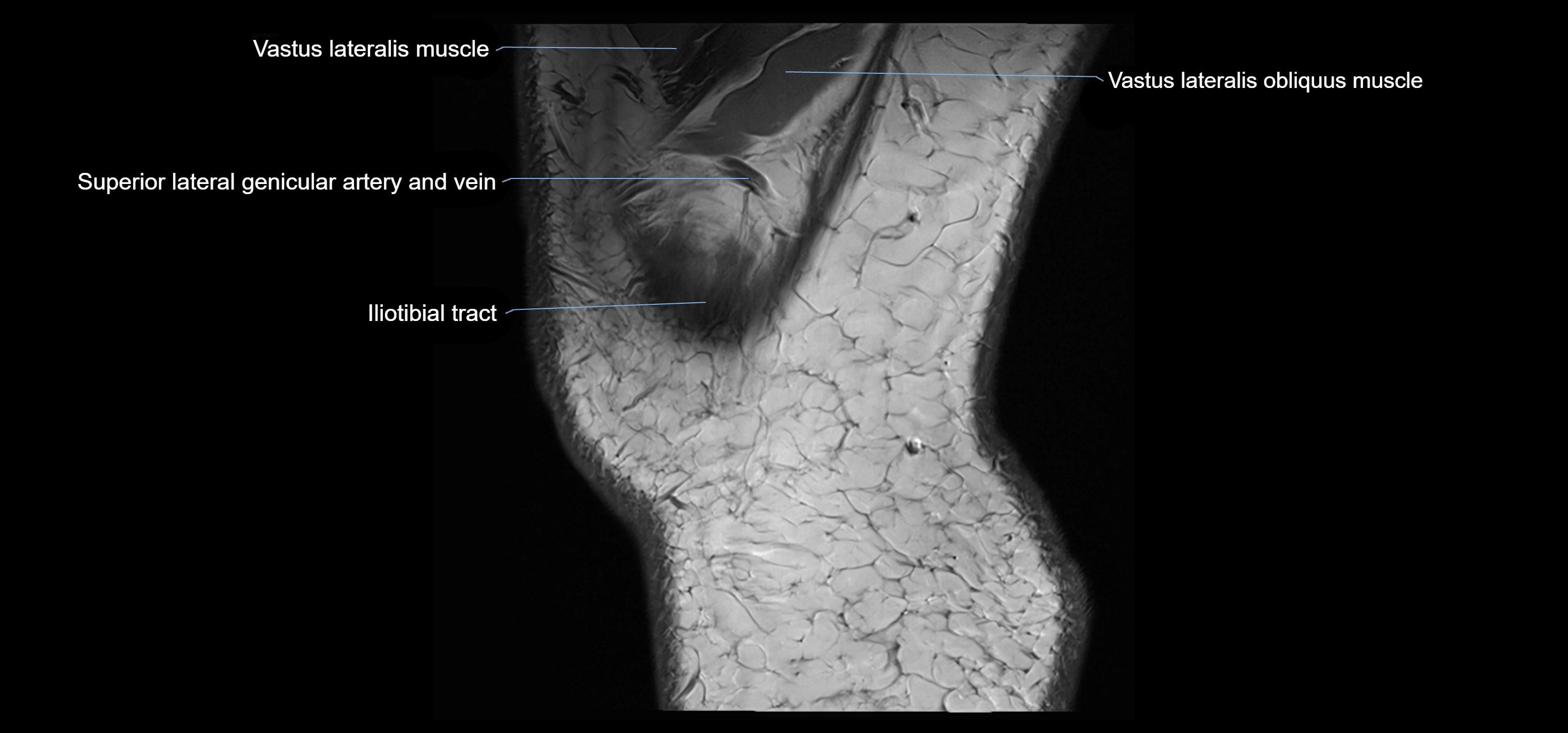 MRI knee sagittal cross sectional anatomy labelled 3T radiology image-00044.webp